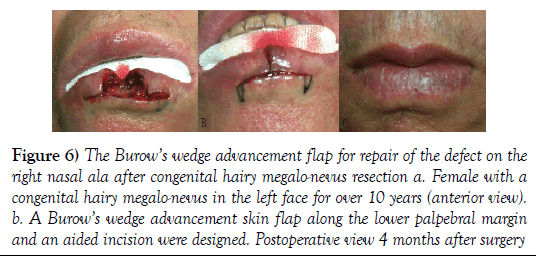 surgery-case-report-Burow-wedge