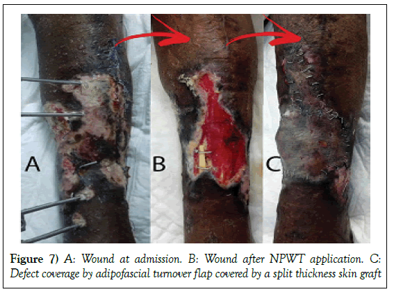 surgery-case-report-adipofascial