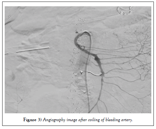 surgery-case-report-angiography