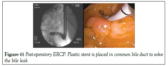 surgery-case-report-bile-leak