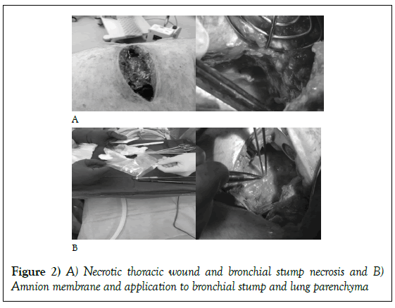 surgery-case-report-bronchial