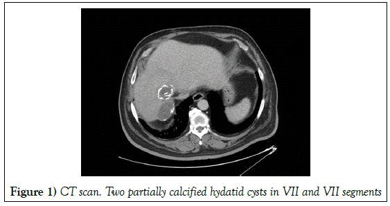 surgery-case-report-calcified