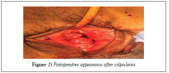 surgery-case-report-colpocleisis