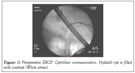 surgery-case-report-cyst-bilia