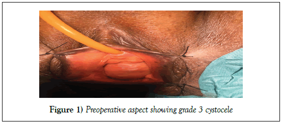 surgery-case-report-cystocele