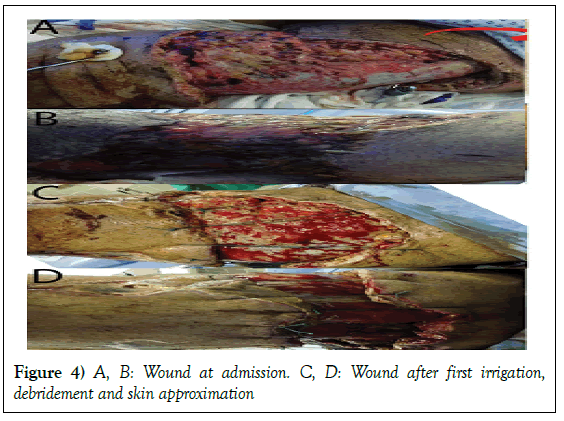 surgery-case-report-debridement