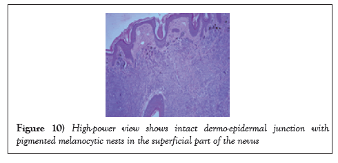 surgery-case-report-dermo-epidermal