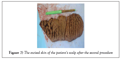 surgery-case-report-excised-skin