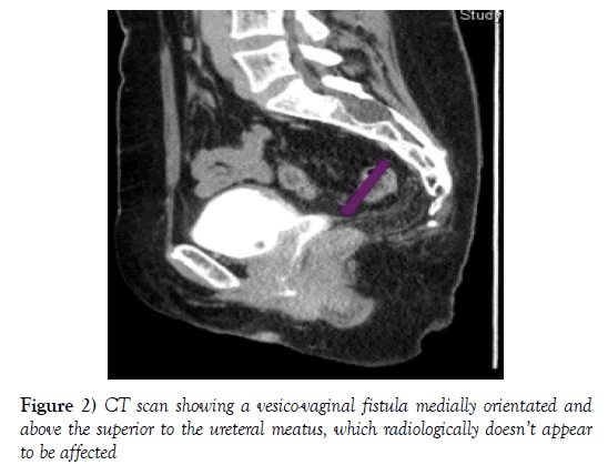 surgery-case-report-fistula-medially