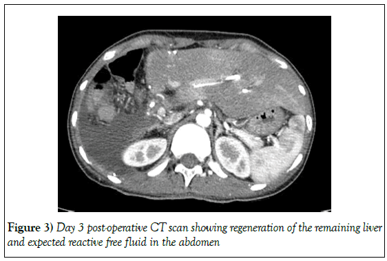 surgery-case-report-free-fluid