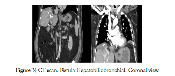 surgery-case-report-hepatobiliobronchial-