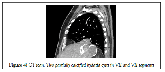 surgery-case-report-hydatid