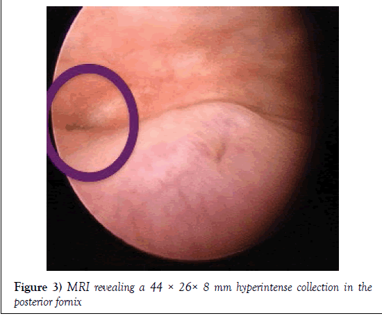 surgery-case-report-hyperintense