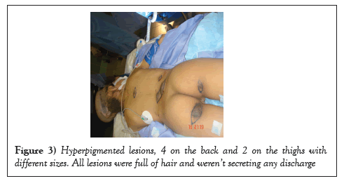 surgery-case-report-hyperpigmented
