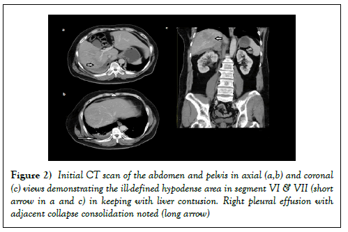 surgery-case-report-hypodense