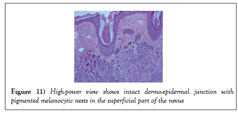 surgery-case-report-melanocytic