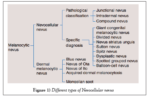 surgery-case-report-nevocellular