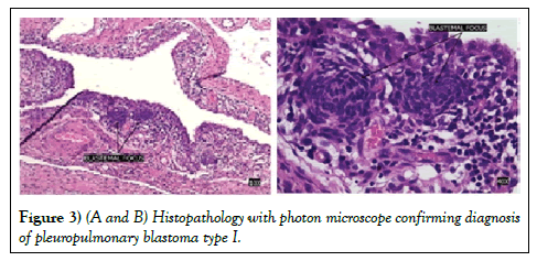 surgery-case-report-pleuropulmonary