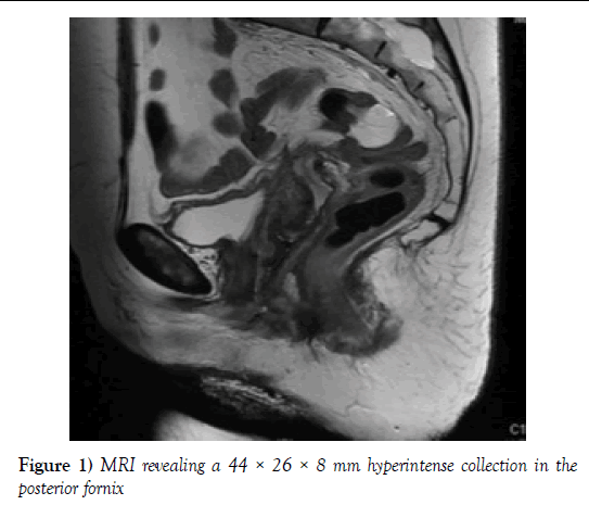 surgery-case-report-posterior-fornix