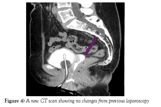 surgery-case-report-previous-laparoscopy