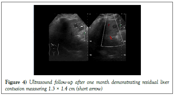 surgery-case-report-residual-liver