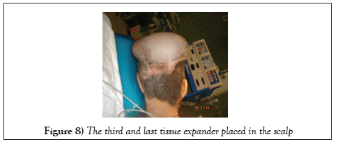 surgery-case-report-scalp