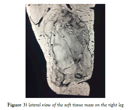 surgery-case-report-soft-tissue-mass