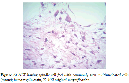 surgery-case-report-spindle-cell-foci