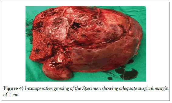 surgery-case-report-surgical-margin