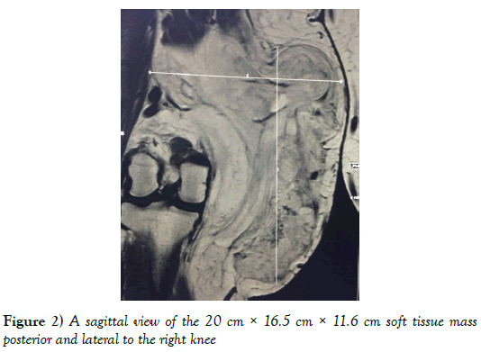 surgery-case-report-tissue-mass-posterior