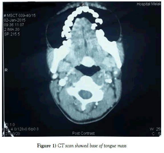 surgery-case-report-tongue-mass