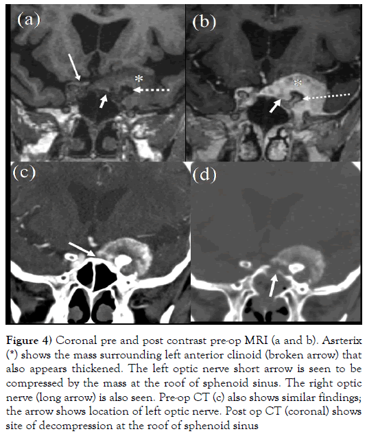 the-neurosurgery-journal-anterior-clinoid