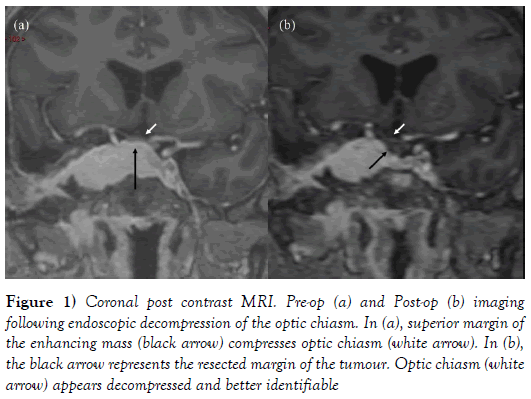 the-neurosurgery-journal-decompression