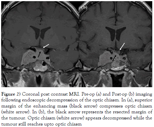 the-neurosurgery-journal-decompression-optic-chiasm