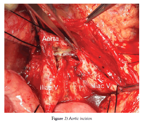 vascular-diseases-treatment-Aortic-incision