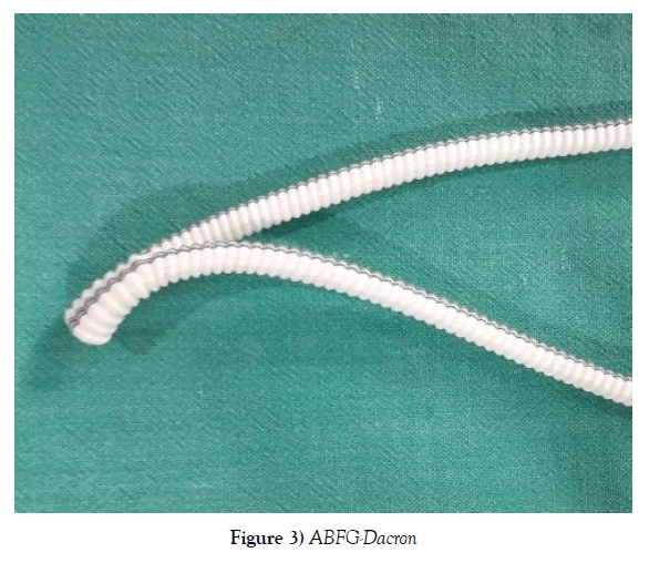 Classical open aorto-bi-femoral grafting is a gold standard technique in  aorto-iliac occlusive disease: The technique of double layered reinforcing  aorto-graft proximal anastomosis with anterior augmentation patchplasty and  its advantages