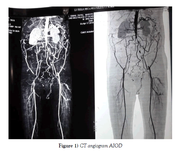 vascular-diseases-treatment-angiogram-AIOD