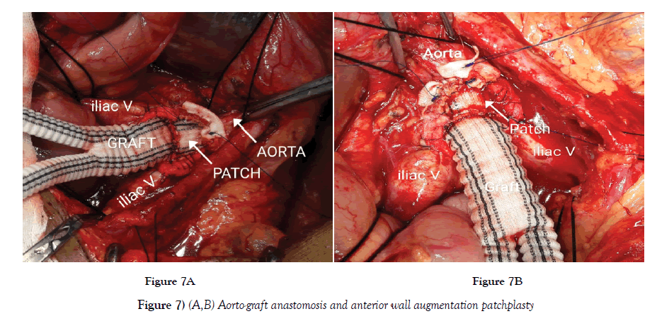 vascular-diseases-treatment-anterior-wall
