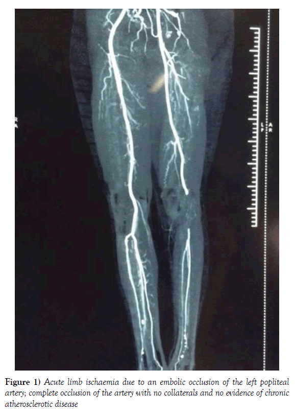 vascular-diseases-treatment-atherosclerotic-disease