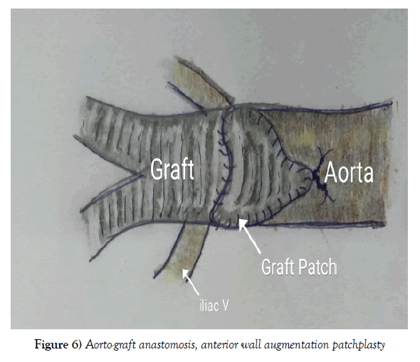 vascular-diseases-treatment-augmentation-patchplasty