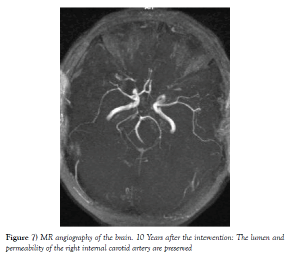 vascular-diseases-treatment-carotid-artery