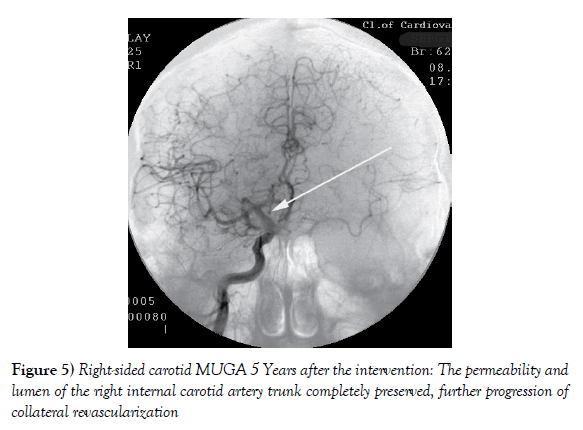 vascular-diseases-treatment-collateral-revascularization