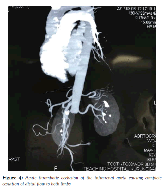 vascular-diseases-treatment-distal-flow