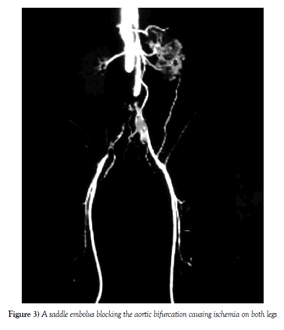 vascular-diseases-treatment-embolus-blocking