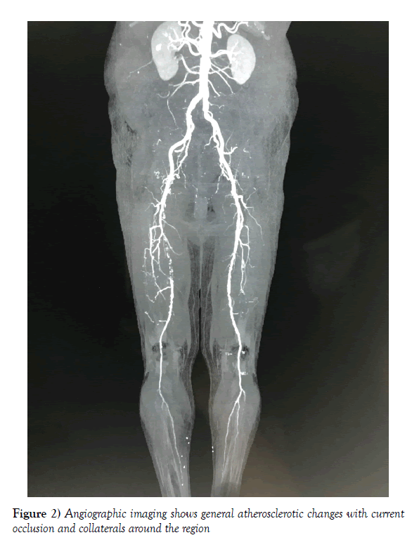 vascular-diseases-treatment-general-atherosclerotic