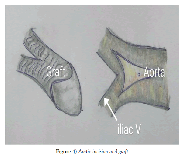 vascular-diseases-treatment-incision-graft
