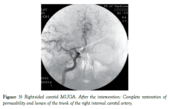 vascular-diseases-treatment-permeability-lumen