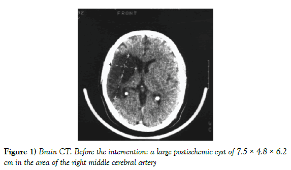 vascular-diseases-treatment-postischemic-cyst