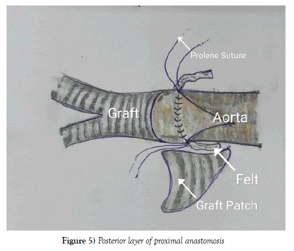 vascular-diseases-treatment-proximal-anastomosis