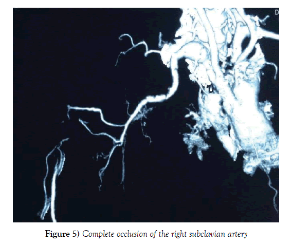 vascular-diseases-treatment-subclavian-artery